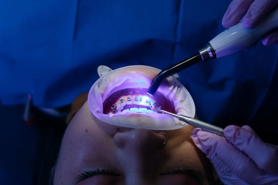 Professional Teeth Whitening for Interview Success